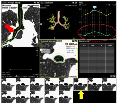 Figure 1 example of continuous airway measurement using the software (4D airways analysis).Notes: On this image, a measurement point is set at the bronchus intermedius (red arrow)