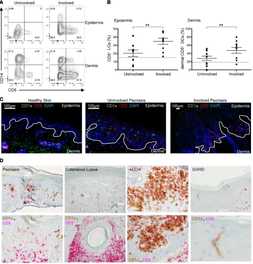 Figure 5. CD5+uninvolved, 32.7% ± 5.2%; involved, 52.2% ± 7.8%. Dashed lines mark the levels of CD5by paired Student’s 100  LCs and dermal DCs are increased in psoriatic lesions compared with nonlesional psoriatic skin