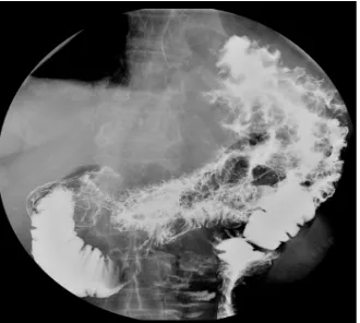 Figure 6. Colon Biopsy—Glandular hyperplastic change, distorted and focally distended crypts, edema, congestion and in- creased lymphoplasmacytic and neutrophilic infiltrates in the lamina propria