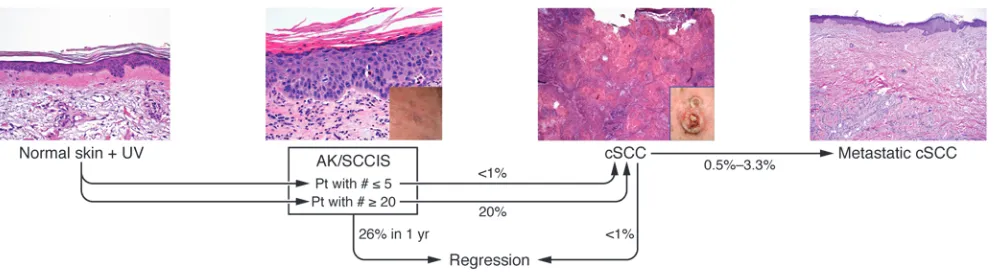 Figure 1Probability that human cutaneous neoplastic lesions will progress to invasive carcinoma