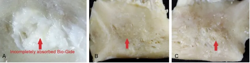 Figure 4. the alveolar bone tissue surrounding it was not obvious. Geistlich Bio-OssA