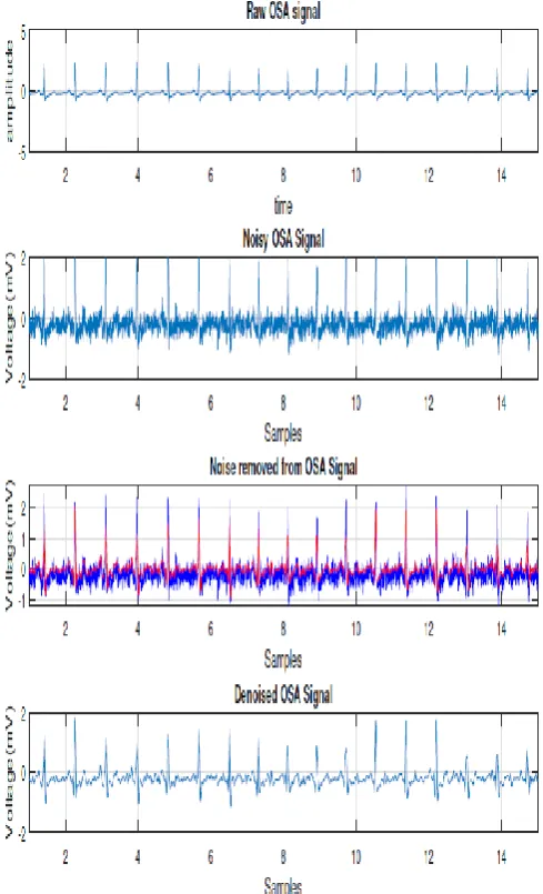 Fig. 9. Sleep Apnea Signal  after applying moving average filter 