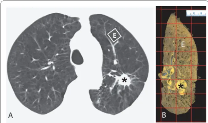Figure 1 Matching CT Images and Lung Specimens. A CT image of a representative subject is shown in Figure 1A and the