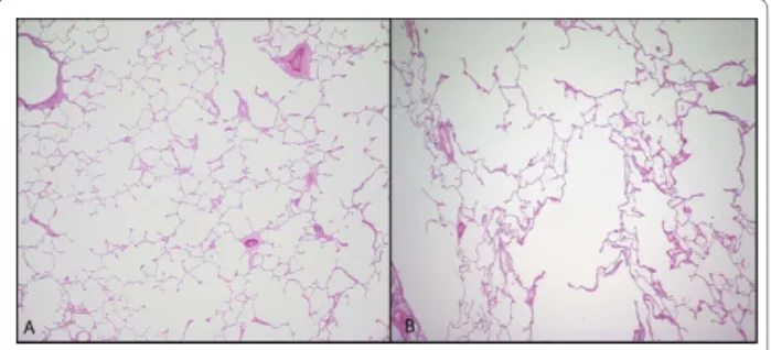 Figure 6 Heterogeneity of Lung Tissue Destruction. Examples of hematoxylin and eosin-stained images of tissue samples taken from the same individual but different lung regions