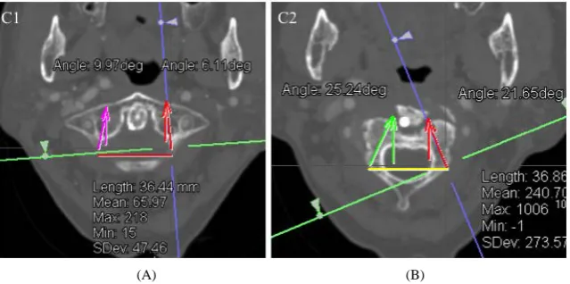 Figure 1. Multi-planar images showing a single best CT image captured from reconstructed 3D CT images of the cervical spine in case of dens fracture