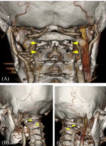 Figure 4. Correlation between surface landmarks, anatomy, and entry points (yellow arrow heads) in case of dens fracture