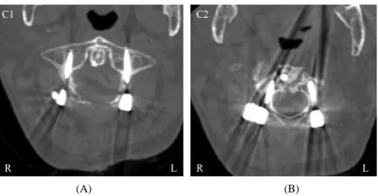 Figure 5. Postoperative axial CT images demonstrate proper insertion of the screws in case of dens fracture