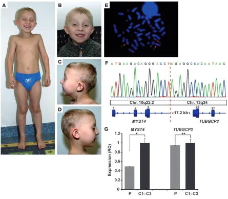Figure 1Phenotype and genetic studies in the patient with MYST4 haploinsufficiency at age 6 years