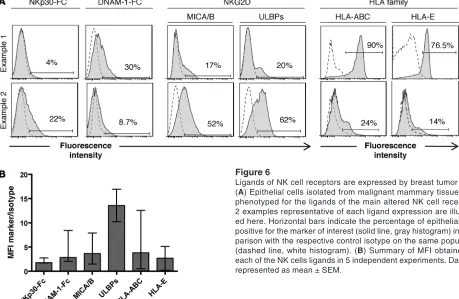 Figure 6Ligands of NK cell receptors are expressed by breast tumor cells. (A) Epithelial cells isolated from malignant mammary tissue were phenotyped for the ligands of the main altered NK cell receptors