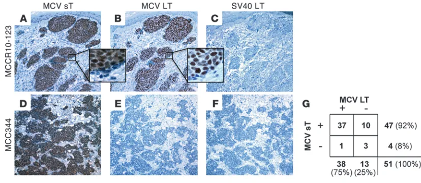 Figure 2MCV sT antigen protein is commonly expressed in MCC. Immunohistochemical staining of adjacent slides from 2 MCC cases with mouse mAbs to MCV sT (CM5E1 antibody) and MCV LT (CM2B4 antibody) is shown