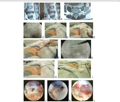 Fig. 6 Male patient (47 years) of L4/5 disc herniation with extruding fragment underwent the procedure of PTES.with the aid of a mallet until the tip of the guiding rod was into the herniated fragmentafter the rod was removed, and pressed down to make the 