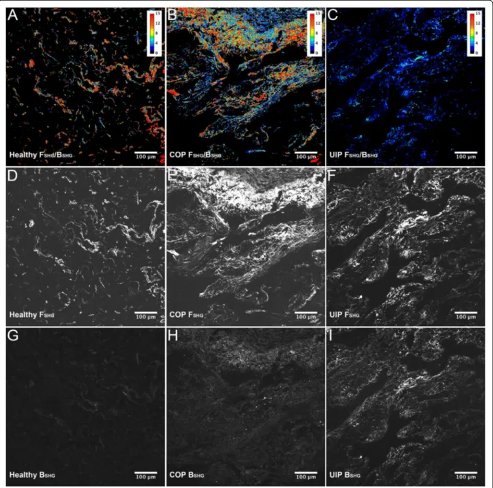 Fig. 2 Illustration of F SHG , B SHG , and F SHG /B SHG imaging as seen in Fig. 1. SHG imaging was performed on healthy, COP, and UIP formalin fixed paraffin embedded human lung tissue, and F SHG , B SHG , and F SHG /B SHG ratio images obtained, as describ