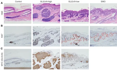 Figure 8Low-level expression of GLI2ΔN gives rise to basaloid hamartomas instead of nodular BCC-like tumors