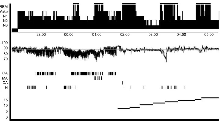 Figure 5 Overnight polysomnogram.Notes: This summary displays a sleep stage hypnogram, oxygen saturation during the study, apnea and hyponea events, and positive airway pressure settings