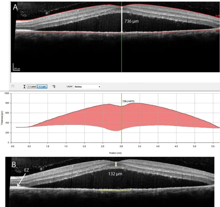 Fig 1. This figure shows an example of potential marked differences between automatic and manual central retinal thickness (CRT) measurements on spectral-domain optical coherence tomography (SD-OCT) in a patient with non-resolving central serous chorioreti