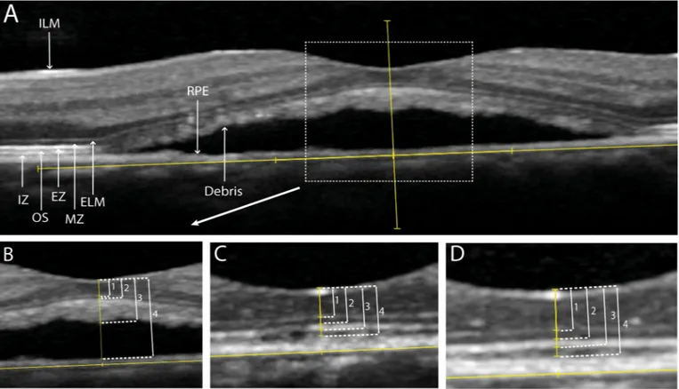 Fig 2. Retinal thickness measurements on spectral-domain optical coherence tomography (SD-OCT) in a patient with non-resolving central serous chorioretinopathy, who was treated with half-dose photodynamic therapy (PDT)
