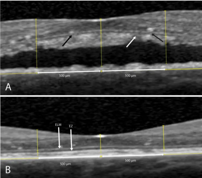 Fig 3. Integrity of the external limiting membrane (ELM) and ellipsoid zone (EZ) on spectral-domain optical coherence tomography in a patient with non-resolving central serous chorioretinopathy, who was treated with half-dose photodynamic therapy (PDT)