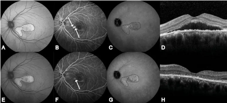 Fig 4. Multimodal imaging of the left eye of a 49-year-old male patient with non-resolving central serous chorioretinopathy