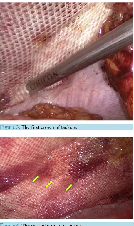 Figure 3. The first crown of tackers.                      