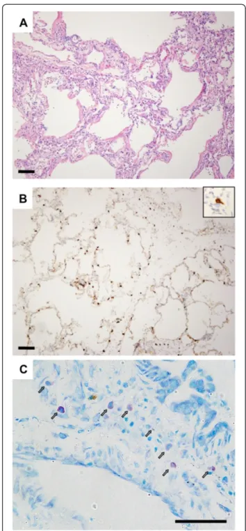 Figure 1 Mast cells in human lung in setting of primary graft dysfunction. (A) Hematoxylin and eosin staining in a lung biopsy taken 3 days following transplant in a patient with severe PGD.