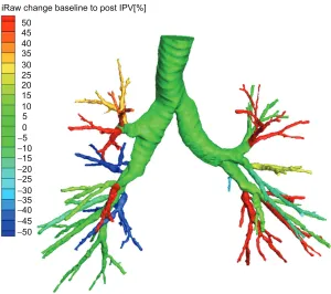Figure 2 Examples of the comparison of individual airways in different COPD patients as assessed with 3D CT analyses at baseline and after intrapulmonary percussive ventilation (IPV) treatment