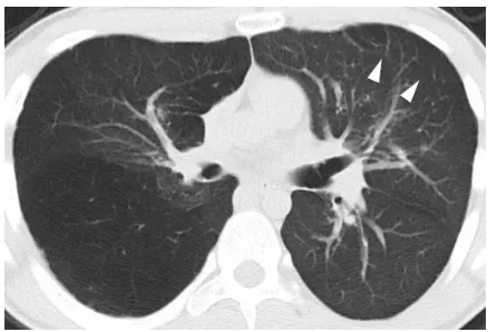 Figure 3 The mediastinum is shifted to the left with diffuse low attenuation in the right lung representing air-trapping