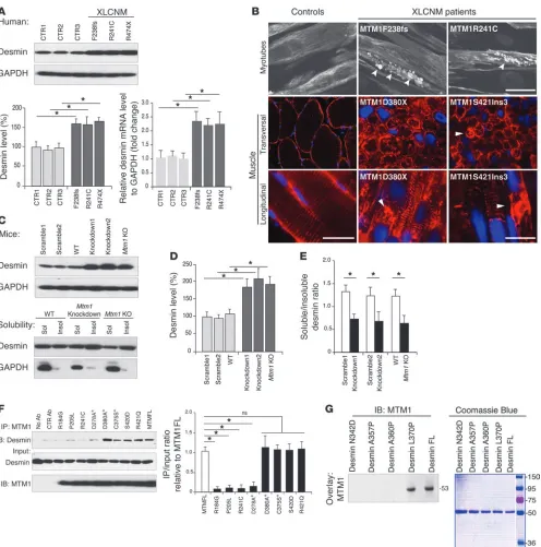 Figure 3Effect of MTM1 depletion and mutation on desmin expression and localization. (A) Desmin was overexpressed in an XLCNM patient’s myoblast 