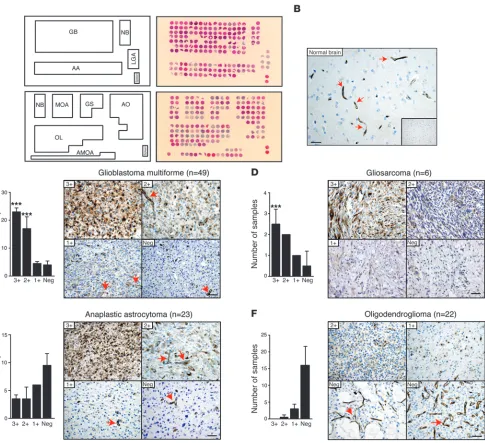Figure 6Evaluation of TfR expression in comprehensive human glioma TMA. (A and B) Glioma TMA maps and H&E-stained tissue sections