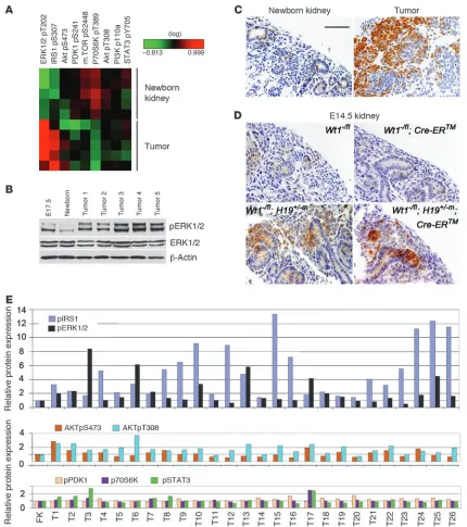 Figure 5Increased pERK1/2 and pIRS1 expression in Wt1-Igf2 tumors and human tumors. (A) Heatmap of RPPA protein expression data in Wt1-Igf2 