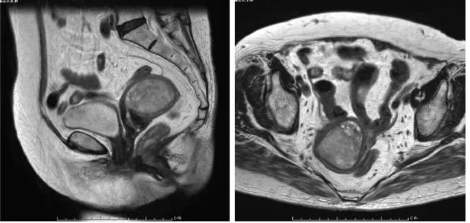 Figure 1. MRI images show a large tumor measuring 5.0 × 4.7 × 3.2 cm in the uterine cavity