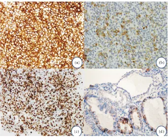 Figure 5. Histopathology of HGNEC in the endometrium. (a) HGNEC cells arrange cord- like structures and monotonously proliferate; (b) HGNEC have round nuclei scanty cyto-plasm