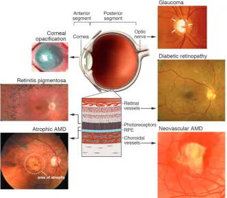 Figure 1Schematic representation of the eye with images of diseases associated with different regions of 