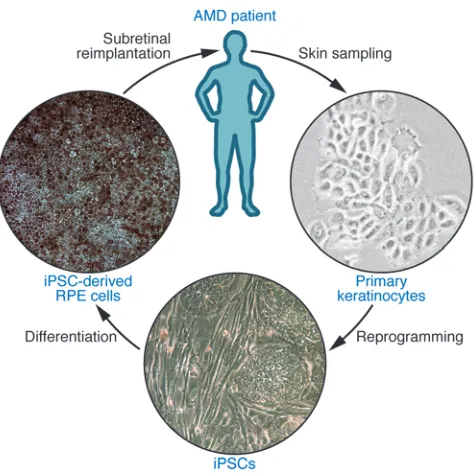 Figure 3Example of a potential treatment strategy for degenerative/dystrophic 