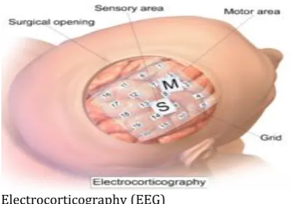 Fig -1: Electrocorticography (EEG) 