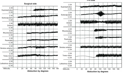 Figure 4 electromyography of patient who had right shoulder rotator cuff repair, and used yoga for subsequent complete left cuff tear.Notes: The right supraspinatus becomes active at 80°, while the left subscapularis shows activity at the same angle, indic