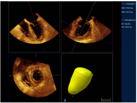 Figure 1 Measurement of LV end-diastolic volume.Notes: After setting five points (S: Septal, L: Lateral, A: Anterior, I: Inferior, Apex), the system automatically tracks the complete LV endocardial borders to calculate the LV volume