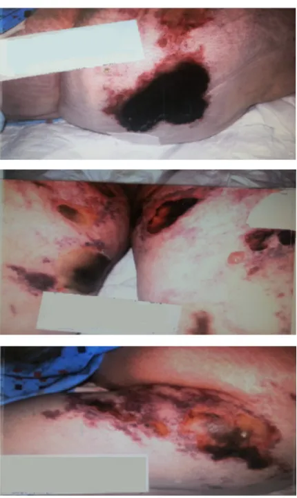 Figure 5 Day 14: necrotic and eschar lesion.