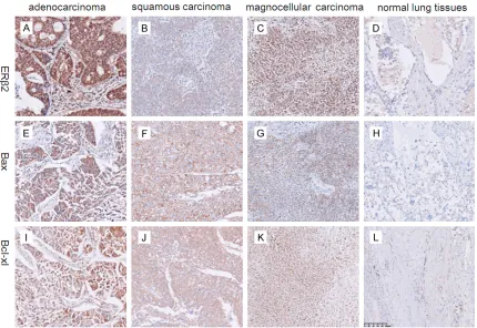 Figure 1. Immunohistochemical analyses of ERβ2, bcl-xl and Bax in NSCLC tissue and BPL tissue.