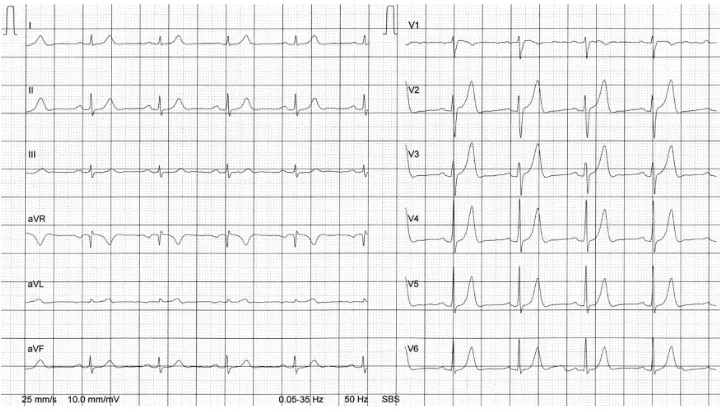 Figure 1 ECG at rest from brother A. Abbreviations: aVF, augmented unipolar limb lead in which the positive electrode is on the left leg; aVL, augmented unipolar limb lead in which the positive electrode is on the left arm; aVR, augmented unipolar limb lead in which the positive electrode is on the right arm; ECG, electrocardiogram; SBS, SCHILLER Baseline-Stabilizer.