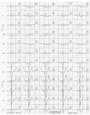 Figure 3 ECG at rest from brother B. 