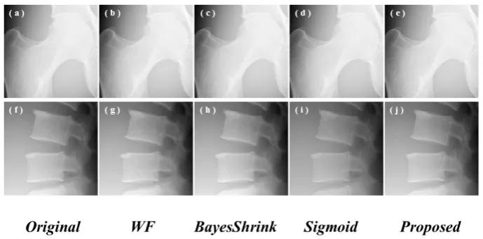 Figure 7. Original phantom images and processed phantom images obtained using WF, Bayes Shrink, sigmoid, and the pro-posed methods