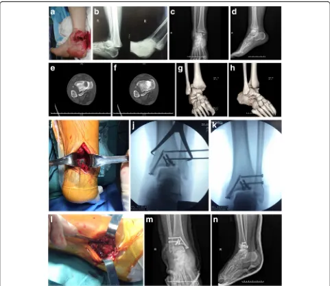 Fig. 3 Prereduction (a, b) and postreduction (c anteroposterior; d lateral) radiographs from a 44-year-old man after traffic accident (typical Logsplitterinjury)