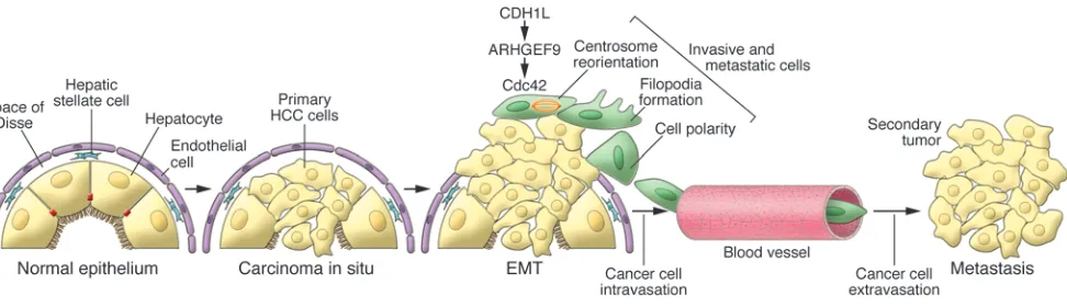 Figure 1Hepatocarcinogenesis and EMT. In healthy livers, hepatocytes exhibit features of epithelial cells because they are polarized and adherent to each 