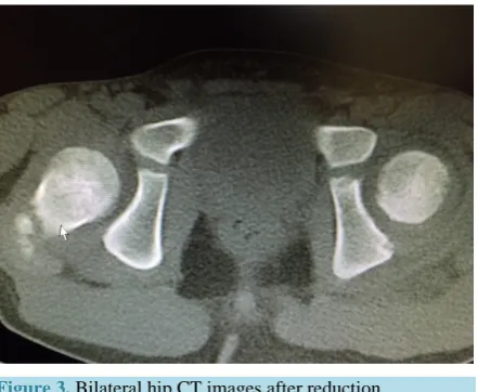 Figure 3. Bilateral hip CT images after reduction. 