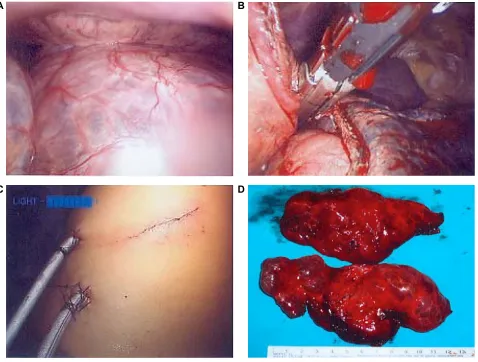 Figure 2 Video-assisted thoracoscopic surgery for patients with bullous emphysema. CA) Giant bullae in the thoracic cavity; B) endo-GIA stapling and resection;  ) Operative wound and drainage; D) Resected bullae, gross picture.