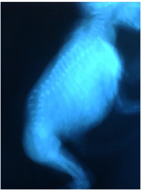 Figure 1 Longitudinal ultrasonographic scans of the spine of a second trimester fetus with hemivertebra.