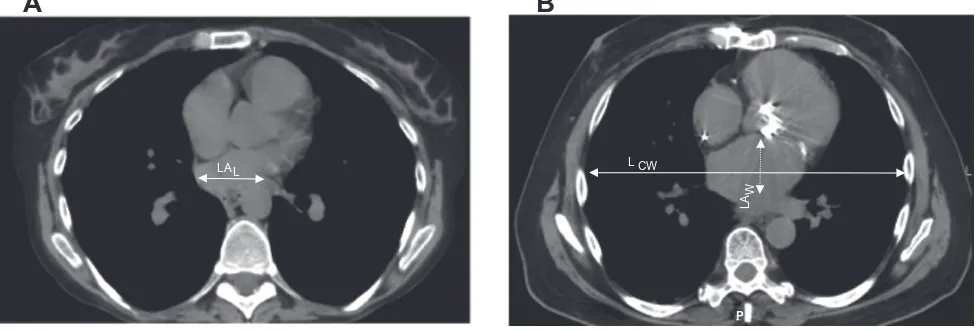 Figure 1 computed tomography of chest at the level of left atrium in pulmonary arterial hypertension determined at the level where the LA appeared largest to the investigator