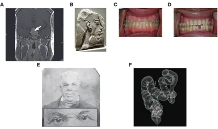 Figure 1Impact of long-term GH and IGFI exposure. (