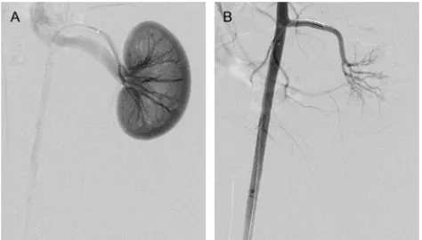 Figure 13 Arterial angiogram of a rabbitembolization.Abbreviation:immediately after embolization (Note:’s left kidney, before embolization (A) andB)