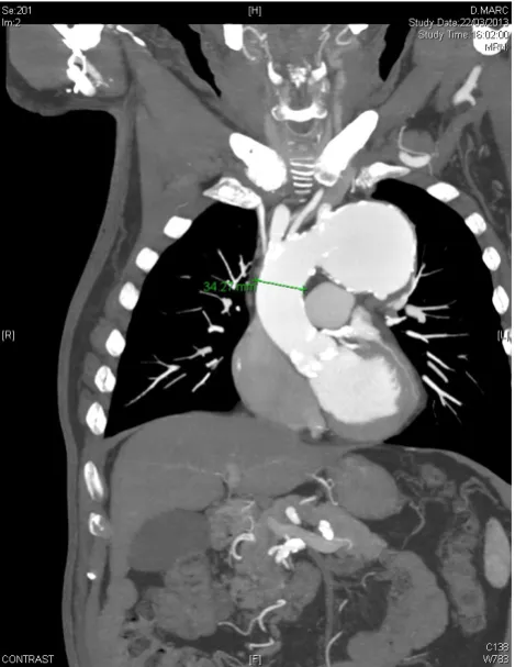 Figure 1. Preoperative enhanced CT scan showing the aortic arch aneurysm. 